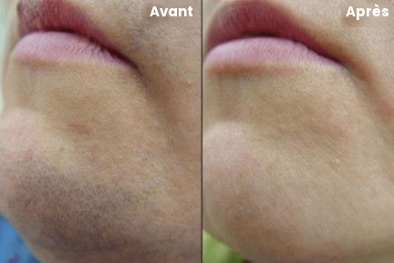 Avant et après l'utilisation du kit OURLUX ™